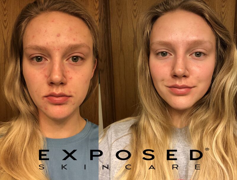 Before and after: customer acne transformation with Exposed Skin Care