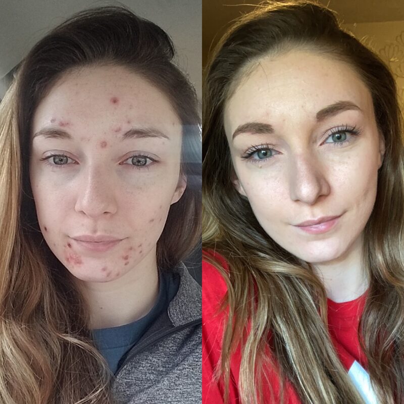 Before and after: Siobhan's acne transformation with Exposed Skin Care